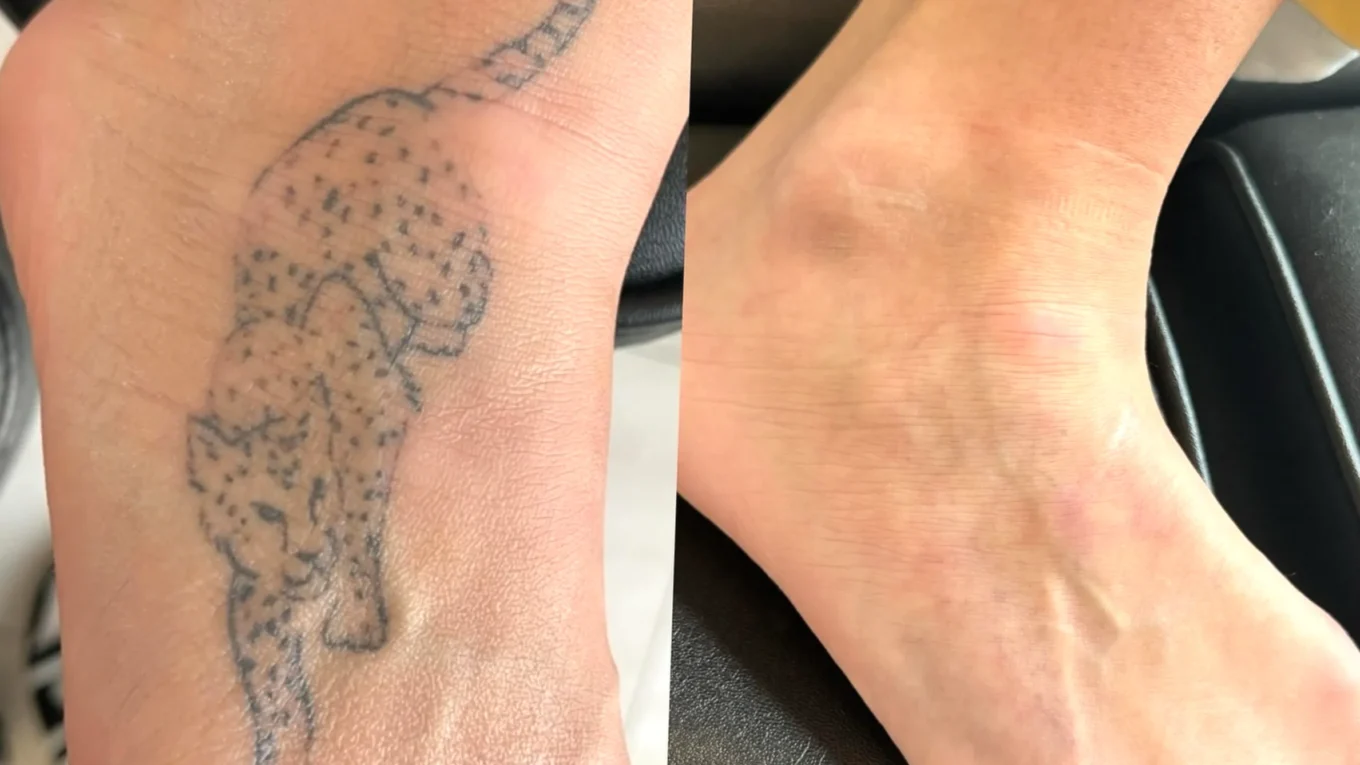 tattoo removal scarring